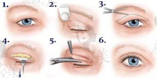 手眼皮手术过程