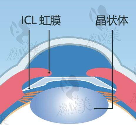 西安晶体植入近视眼手术价格