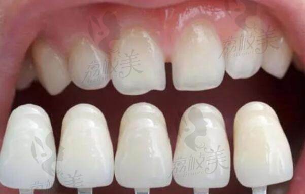 保定涿州哪里可以做牙贴片的？