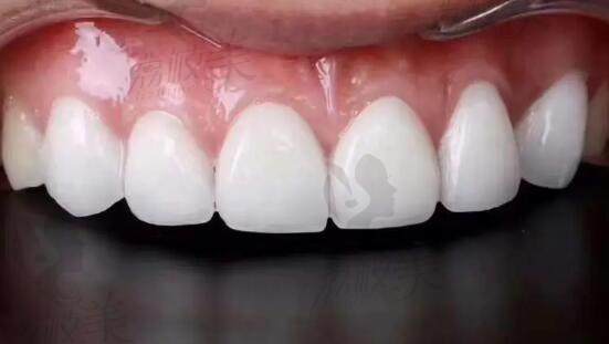 牙齿贴面是什么？适应人群有哪些？
