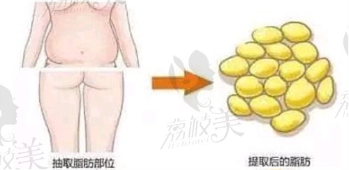 西安叶子整形医院脂肪填充医生推荐徐佳明