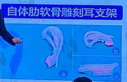 北京丽都自体肋软骨直埋法