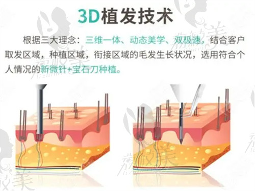 南京青云植发张亮医生植发技术高超