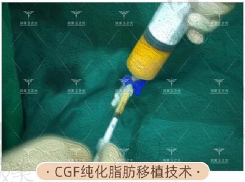 张红芳医生CGF纯化脂肪丰胸术