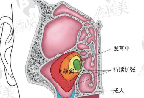 上颌窦内提升和外提升的区别在哪里