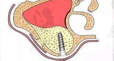 上颌窦内提升和外提升的区别在哪里