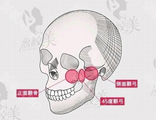 郑州赵绛波医生做颧骨内推手术的技术原理