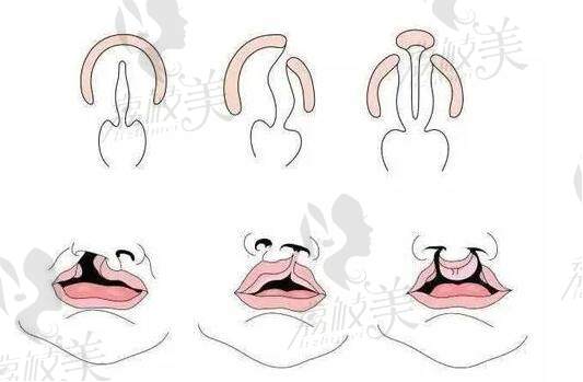 广州余文林唇裂修复怎么样