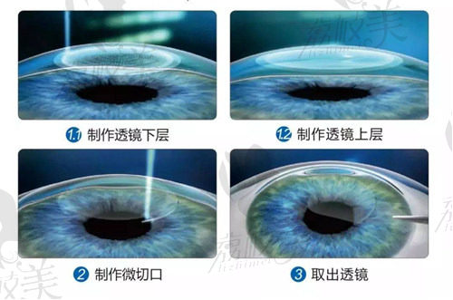 广州视百年眼科做激光全飞秒近视手术的优势