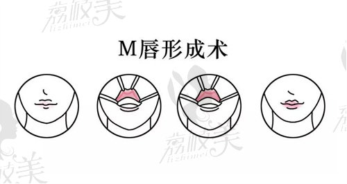 m唇手术过程