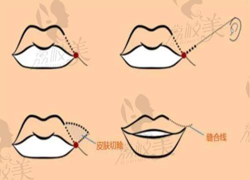 预防嘴角两边下垂的方法
