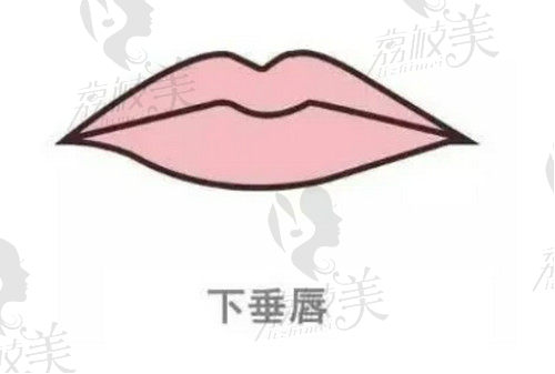 嘴角下垂是什么原因