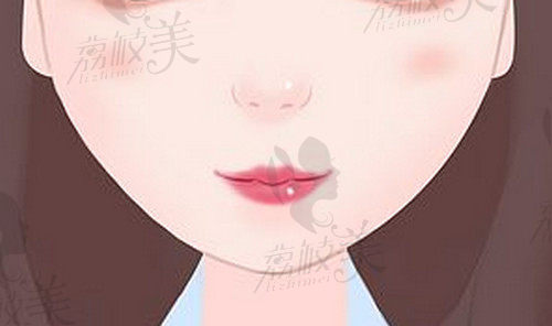 嘴角上扬整形怎么做的