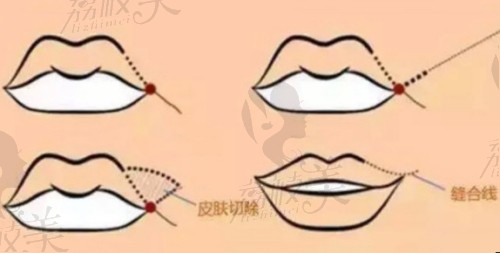 嘴角上扬整形过程