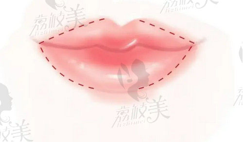 嘴角上扬术手术方法