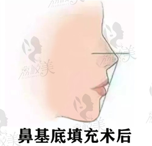 鼻基底填充术后