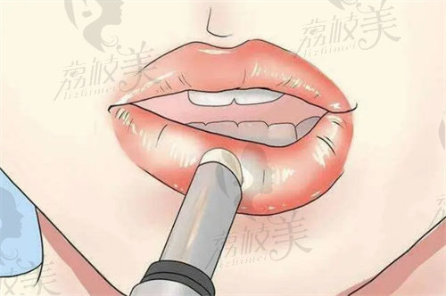 做m唇手术能维持多久？
