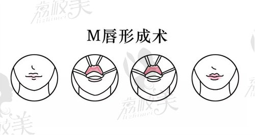 m唇手术