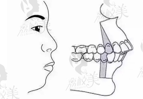 北京联合丽格双颌前突矫正术