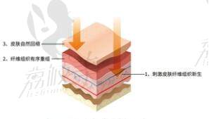 王世虎脂肪填充怎么样