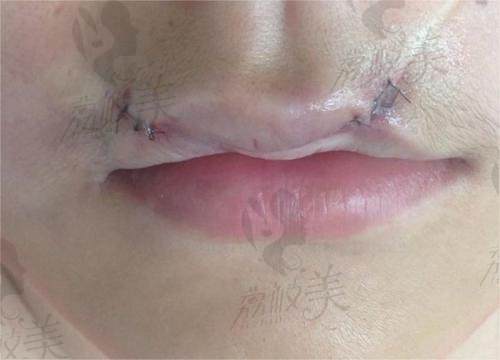 北京嘴唇疤痕修复整形收费标准