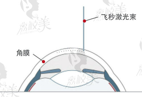 南京东南眼科医院飞秒手术价格