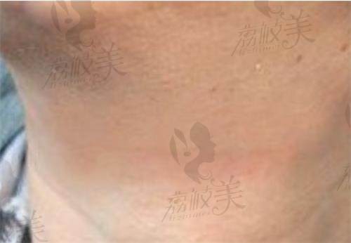 武汉正璞刘光华医生祛疤技术好