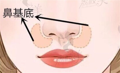 杭州填充鼻基底技术好的医生