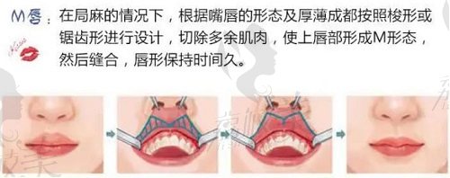 厚唇改薄手术过程