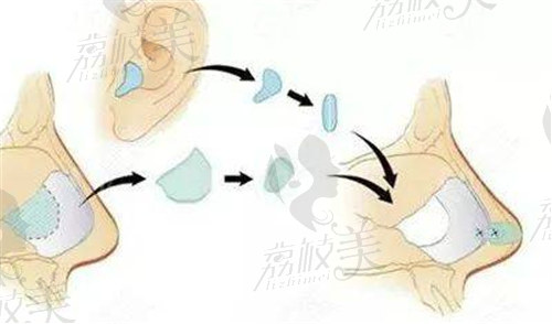 耳软骨垫鼻尖摸上去硬硬的多久可以恢复？