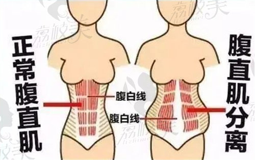 肖添有医生腹壁成型