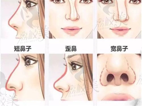 广州华美高顺福做的鼻修复怎么样？
