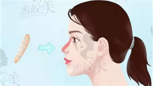 广州华美高顺福做的鼻修复优势