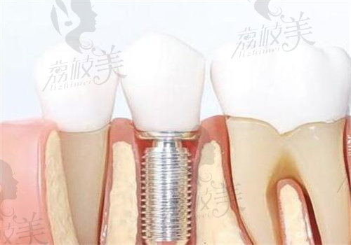 韩国奥齿泰种植牙材料可靠
