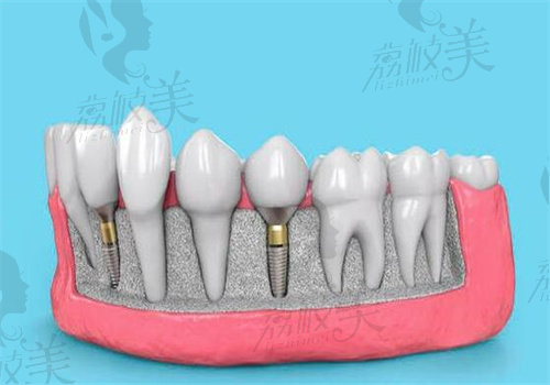 韩国奥齿泰种植牙美观度高