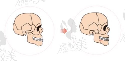 柳春明医生下颚前突矫正术后范例反馈评价