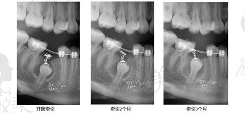 侯旭醫(yī)生病例圖片（含牙囊腫的埋伏牙牽引）