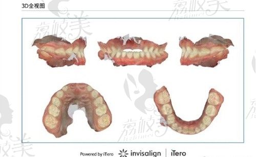 侯旭醫(yī)生病例圖片（iTero智能口掃）