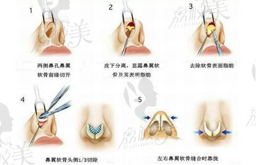 双侧鼻翼软骨内脚靠拢法鼻头缩小术