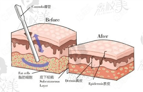 南京友谊医院林金德医生吸脂怎么样？