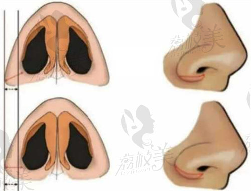 鼻骨矫正治疗方法