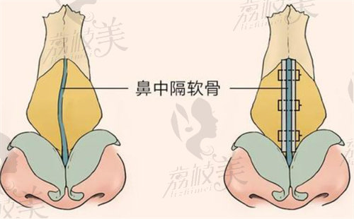 鼻梁骨歪斜矫正过程