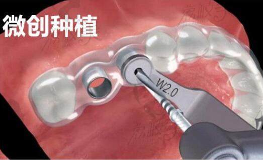 2023杭州种植牙技术好的医生推荐（关呈超、陈丹军、梁启强超多口碑）