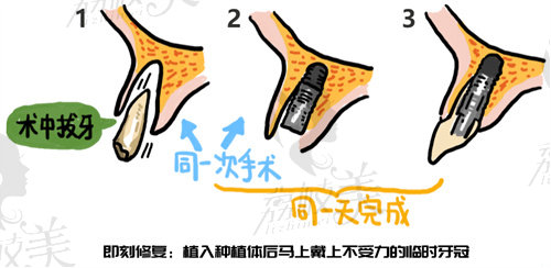 西安哪里种植牙便宜质量好