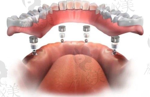珠海九龙口腔医院半口半固定种植牙
