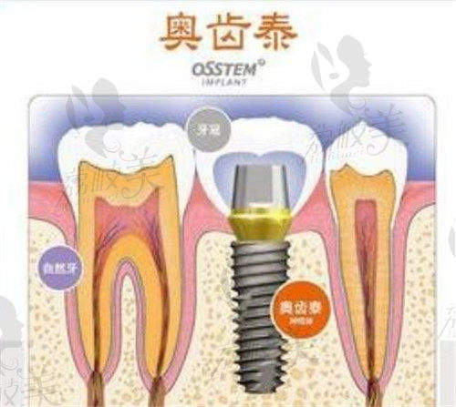 韩国奥齿泰种植牙