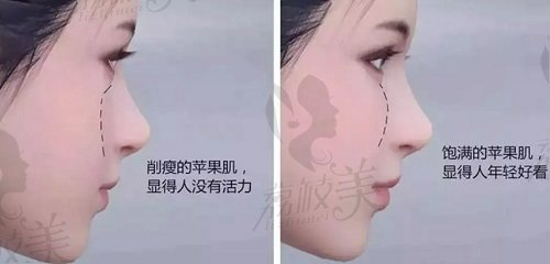 自体脂肪填充苹果肌多久恢复自然？