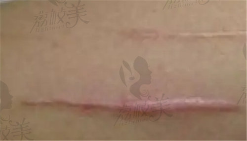 广州曙光医学美容医院疤痕修复的优势
