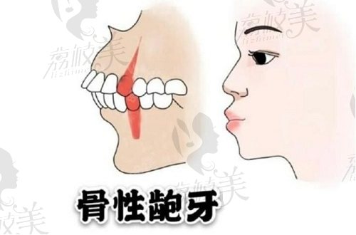 骨性凸嘴矫正手术的预约挂号方式