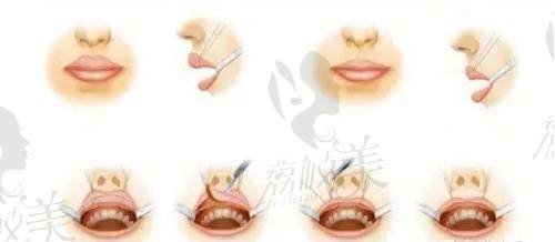 整形嘴唇常见的方法